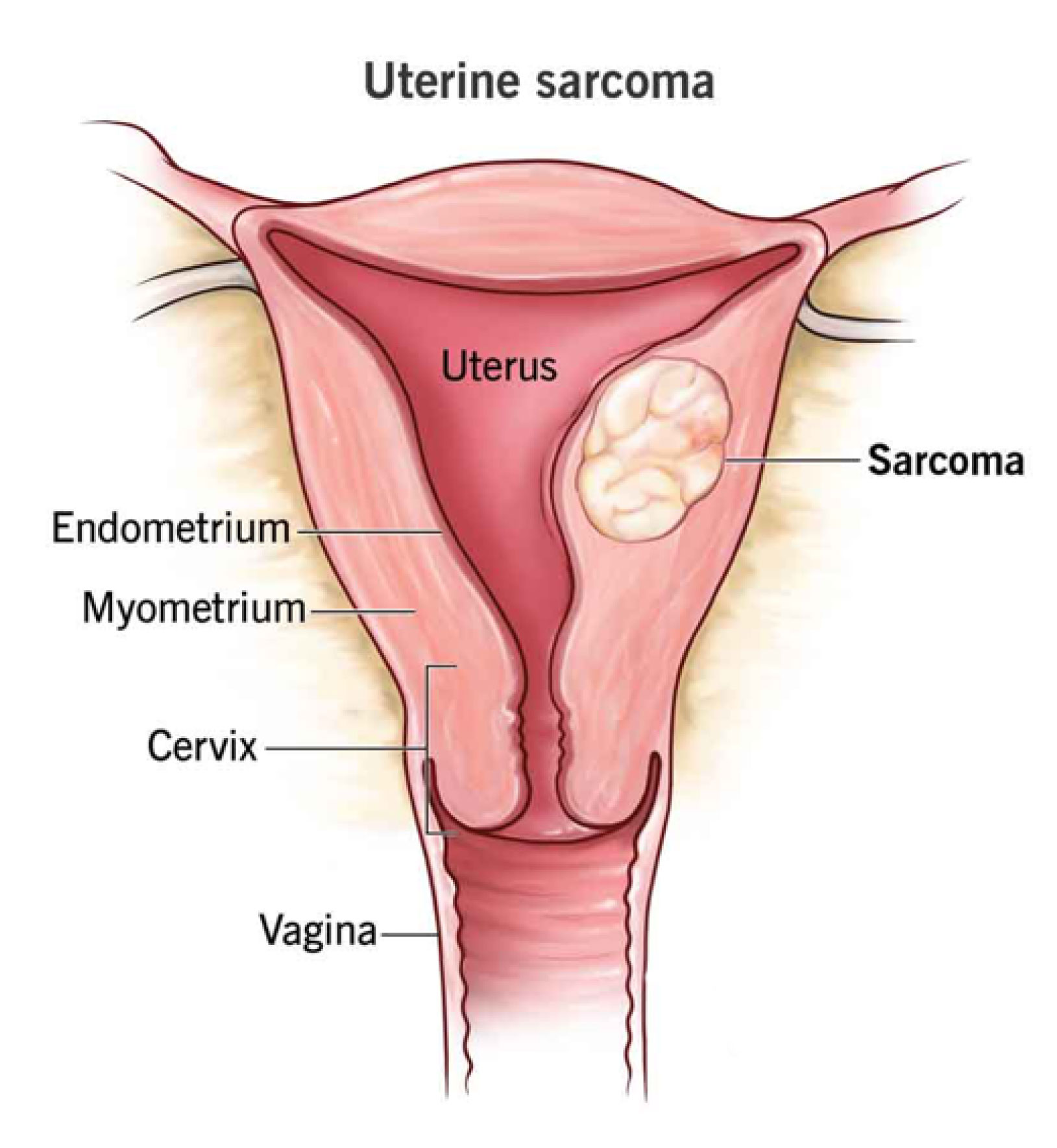 Cancerul-uterin