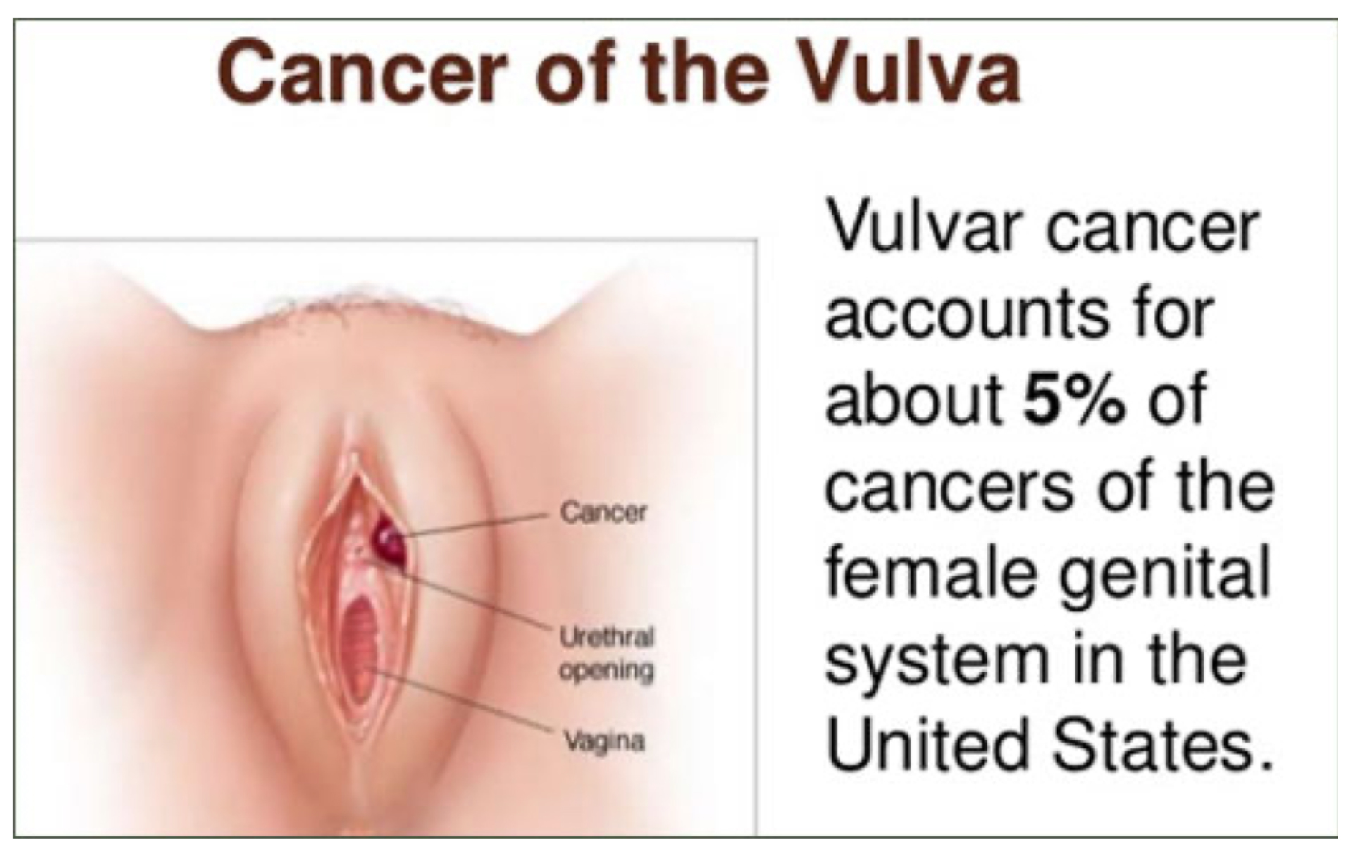 cancer-vulvar