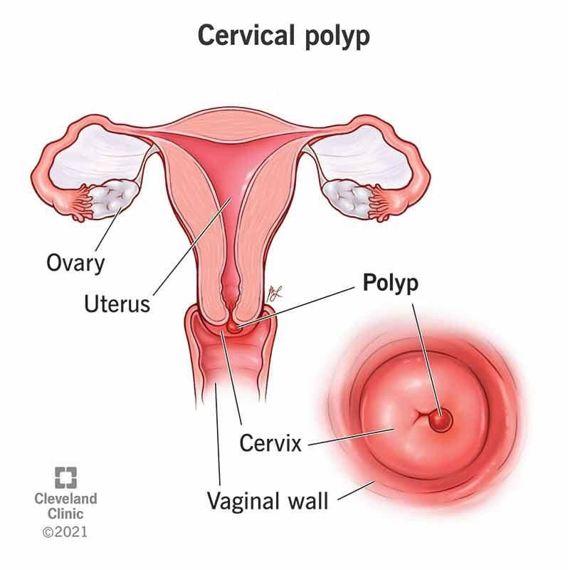 polip-cervical