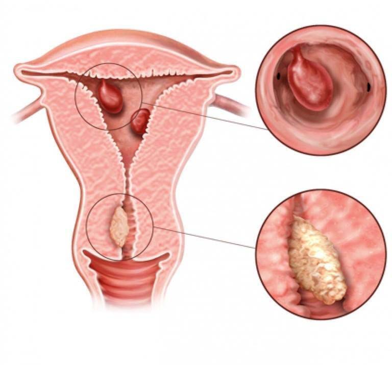 polip endometrial