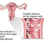 vulvovaginita